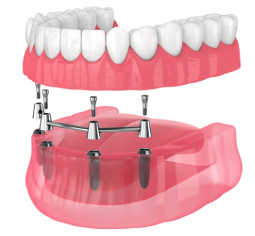 Implant Denture Bar