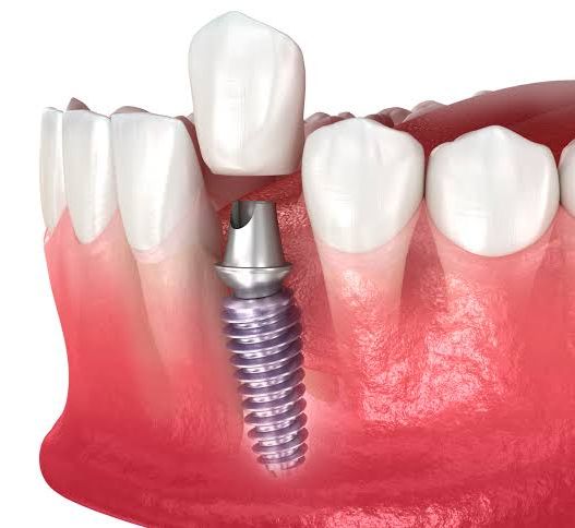 implant