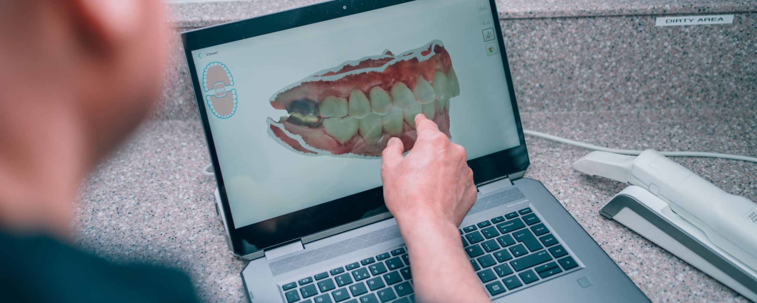 Intra-Oral Scanner at Shenstone Dental Centre 