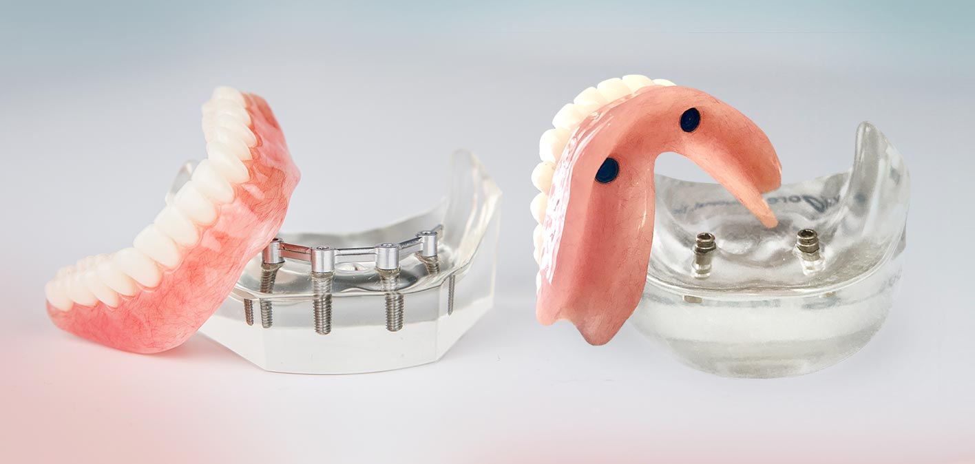 Models showing dental implants supporting a full set of replacement teeth